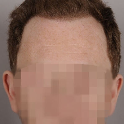 ▷ 16+ Best Hair Transplant Doctors in Mexico (Cost & Before and After)
